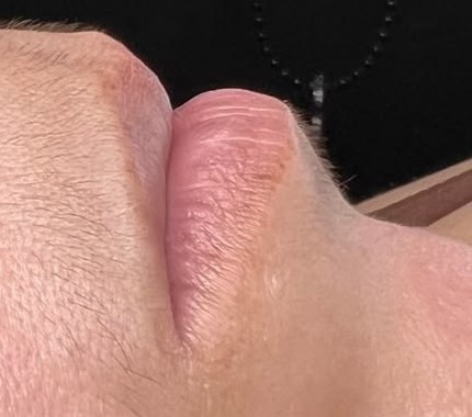 Pelos antes da epilação